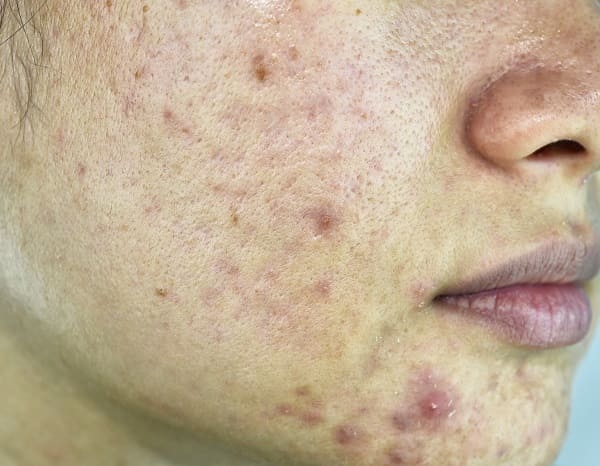 ミレム-ビュートリックの効果　使用前のお肌の状態